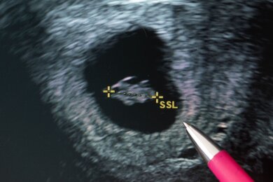 Eine Frauenärztin deutet auf den Fötus im Ultraschallbild.