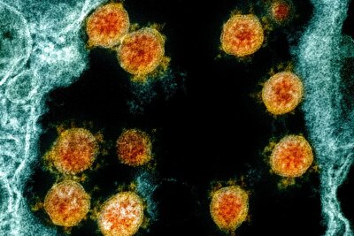 613 Tage lang Corona: Seltener Infektionsfall vorgestellt - Partikel des Coronavirus SARS-CoV-2 wurden für eine elektronenmikroskopische Aufnahme farblich bearbeitet.