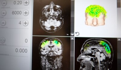Alzheimer: Stoßwellen wecken Nervenzellen auf - Auf einem Bildschirm kann die Ärztin den Einsatz der Stimulationsimpulse in einzelnen Hirnregionen auf Basis eines MRT-Bildes verfolgen. 