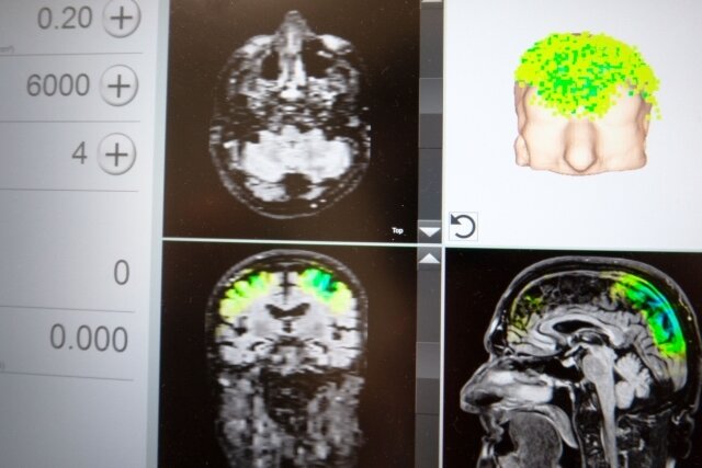 Auf einem Bildschirm kann die Ärztin den Einsatz der Stimulationsimpulse in einzelnen Hirnregionen auf Basis eines MRT-Bildes verfolgen. 