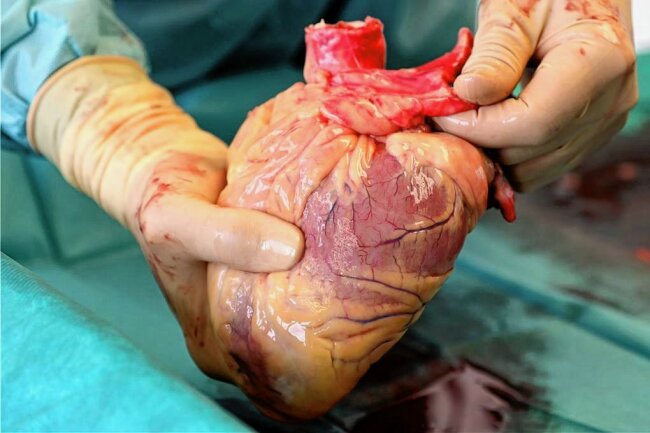 Bereitschaft zur Organspende wächst - Ein Transplantationsmediziner mit dem Herz eines Verstorbenen. 