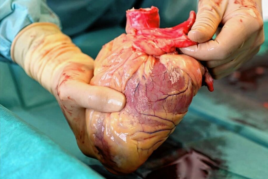 Bereitschaft zur Organspende wächst - Ein Transplantationsmediziner mit dem Herz eines Verstorbenen. 
