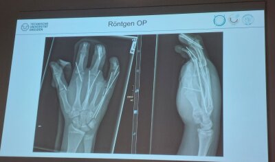 Böller reißt 14-Jährigem fast die Hand ab - Das Röntgenbild zeigt, wie die Knochen in Felix' Hand fixiert wurden.