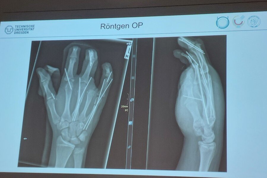 Böller reißt 14-Jährigem fast die Hand ab - Das Röntgenbild zeigt, wie die Knochen in Felix' Hand fixiert wurden.