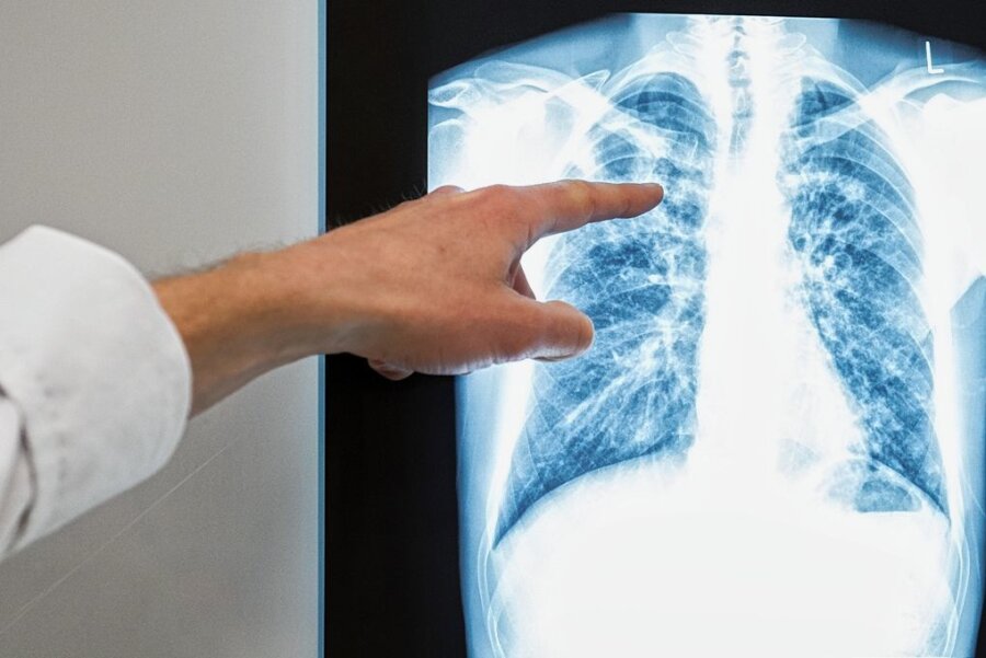 Chemnitz meldet Fall von offener Tuberkulose: Zahlreiche Ansteckungen festgestellt - In Chemnitz sind erneut Tuberkulosefälle aufgetreten. Auch das Gesundheitsamt in Annaberg untersucht mögliche Betroffene.