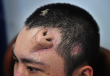 Chinesische Ärzte züchten Nase auf Stirn eines Mannes - 