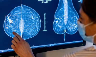 Einsatz von KI verändert Arbeitsweisen an Kliniken - Medizinisches Personal untersucht mit einer Mammografie die Brust einer Frau auf Brustkrebs.