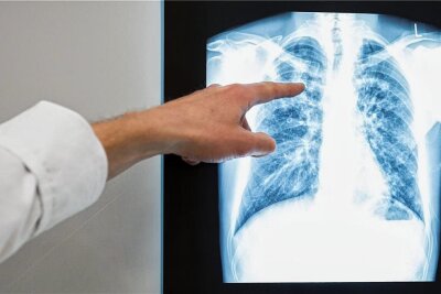 Erneut offene Lungentuberkulose in Chemnitz festgestellt - Als bakterielle Infektionskrankheit befällt die Tuberkulose hauptsächlich die Lunge. In Deutschland tritt sie mit fünf bis sechs Erkrankten pro 100.000 Einwohnern eher selten auf.