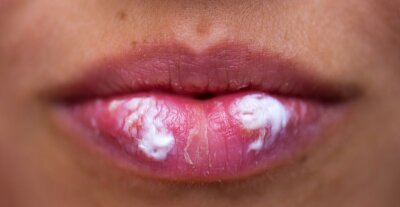 Herpes bleibt für immer - Cremen gegen hässliche Bläschen.