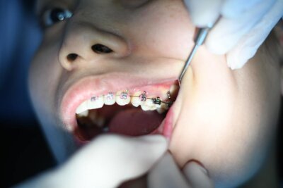 Jedes zweite Kind braucht eine Spange - Kein Makel mehr: Fast jedes zweite Kind in Deutschland bekommt eine Zahnspange, meist eine festsitzende mit Brackets aus Metall, Keramik oder Kunststoff. 
