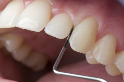Krankes Zahnfleisch wird oft zu spät behandelt - 