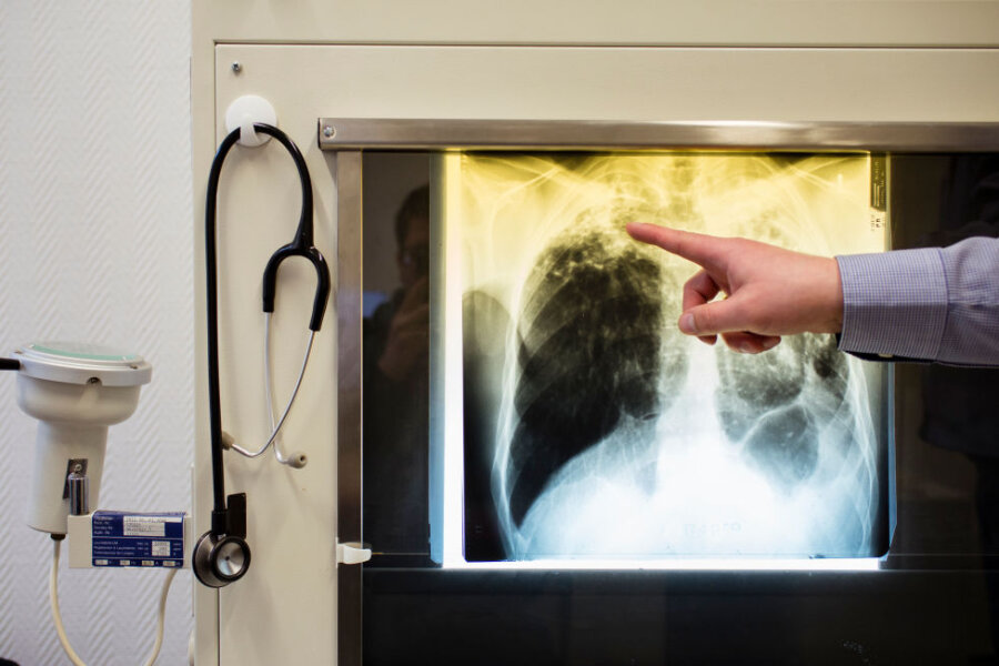 Nach Tuberkulose-Ausbruch in Chemnitz: Neue Hotline in Sachsen - In Chemnitz sind vier Fälle von Lungentuberkulose bestätigt. Weil die Unsicherheit wächst, schaltet die Barmer ein Hilfsangebot.