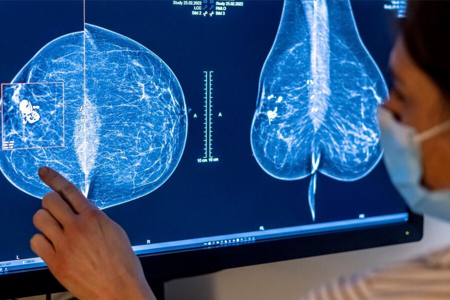 Patienten mit Brustkrebs und Herzinfarkt erhalten oft nicht die beste Behandlung - Zeigt das Mammografiebild Brustkrebs? In Deutschland erkrankt eine von acht Frauen im Laufe ihres Lebens daran.