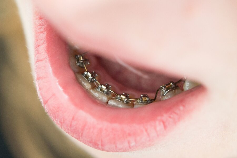 Regionale Unterschiede bei kieferorthopädischer Behandlung - Gegen schiefe Zähne hilft eine Zahnspange.