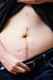 Schicksal Morbus Crohn - eine Patientin erzählt - Morbus Crohn kann den kompletten Verdauungstrakt betreffen - von der Speiseröhre bis zum After und alle Schichten der Darmwand. 