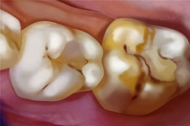 So schlimm sehen Kreidezähne bei Kindern aus - und das können Sie dagegen tun - Kreidezähne haben gelblich-bräunliche Flecken. 