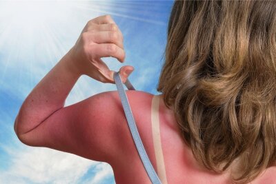 Sonnenbrand: Diese Cremes und Medikamente helfen dagegen - Autsch. Hier ist der Sonnenschutz eindeutig zu kurz gekommen. 