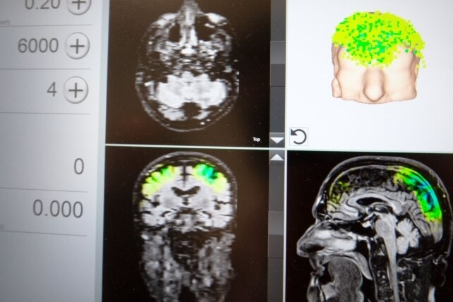 Stoßwellen wecken Nervenzellen auf - Auf einem Bildschirm kann die Ärztin den Einsatz der Stimulationsimpulse in einzelnen Hirnregionen auf Basis eines MRT-Bildes verfolgen. 