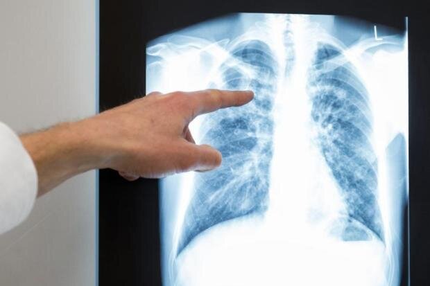 Tuberkulose-Fall an Chemnitzer Kita - 
