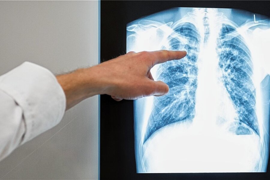 Tuberkulose: Gesundheitsamt gibt Entwarnung - Ein Arzt zeigt auf das Röntgenbild einer Lunge (Symbolbild). Nachdem in Chemnitz Fälle von Lungentuberkulose festgestellt worden sind, hat das Gesundheitsamt in Mittelsachsen aktuell keine Hinweise auf positiv getestete Personen. 