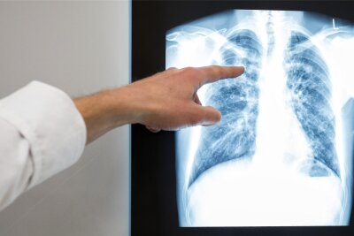 Tuberkulose in Chemnitz: Erkrankte wird weiterhin im Krankenhaus behandelt - Zur Diagnose einer Tuberkulose wird zumeist ein Röntgenbild hinzugezogen.
