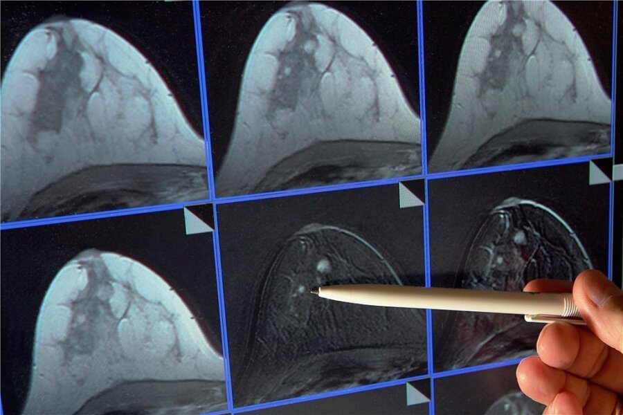 Abklärungsdiagnostik nach positivem Screeningbefund - im MRT ist ein kleiner Tumor in der Brust zu sehen. 