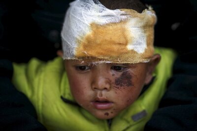 Zwischen Hoffen und Helfen - Gezeichnet von der Katastrophe: ein vierjähriger Junge im Krankenhaus von Dhading, westlich von Kathmandu.